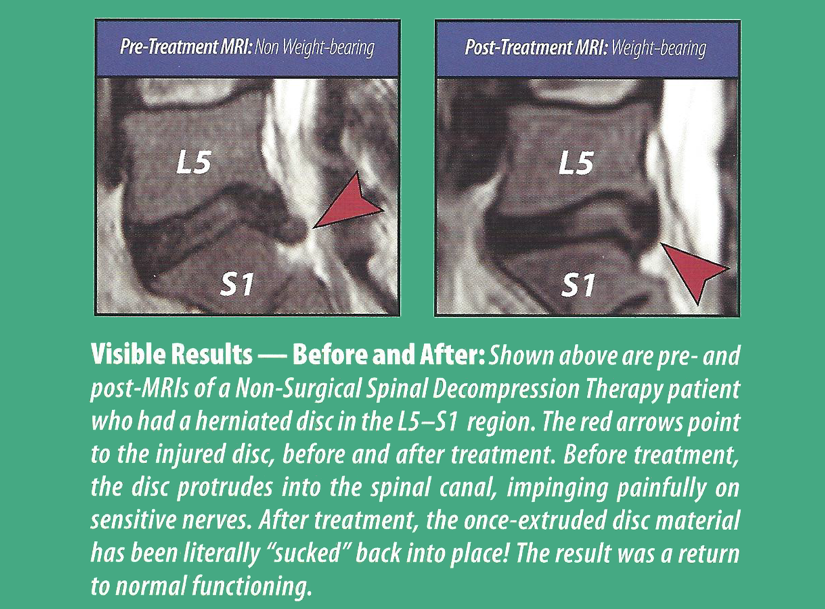 Spinal Decompression Therapy – The Spine Center