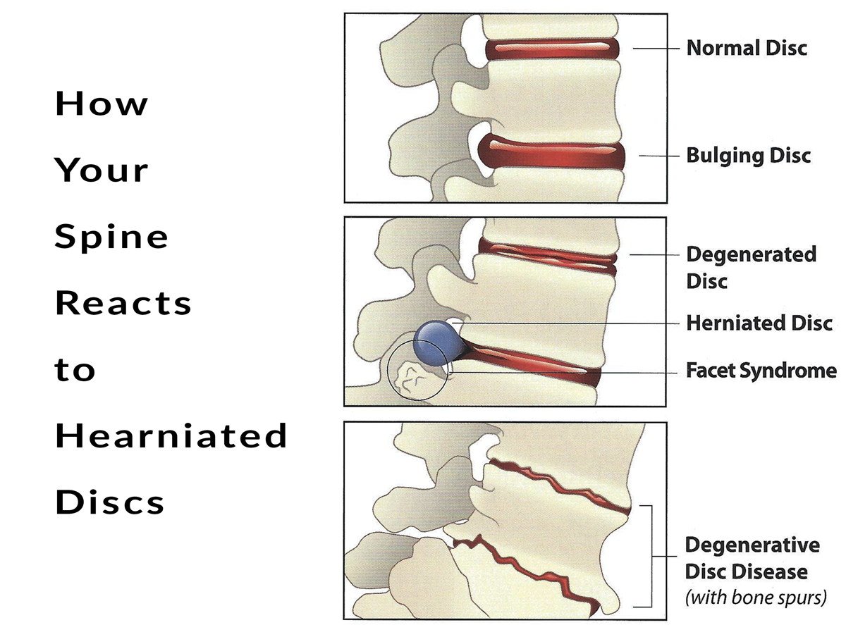 How To Decompress Spine